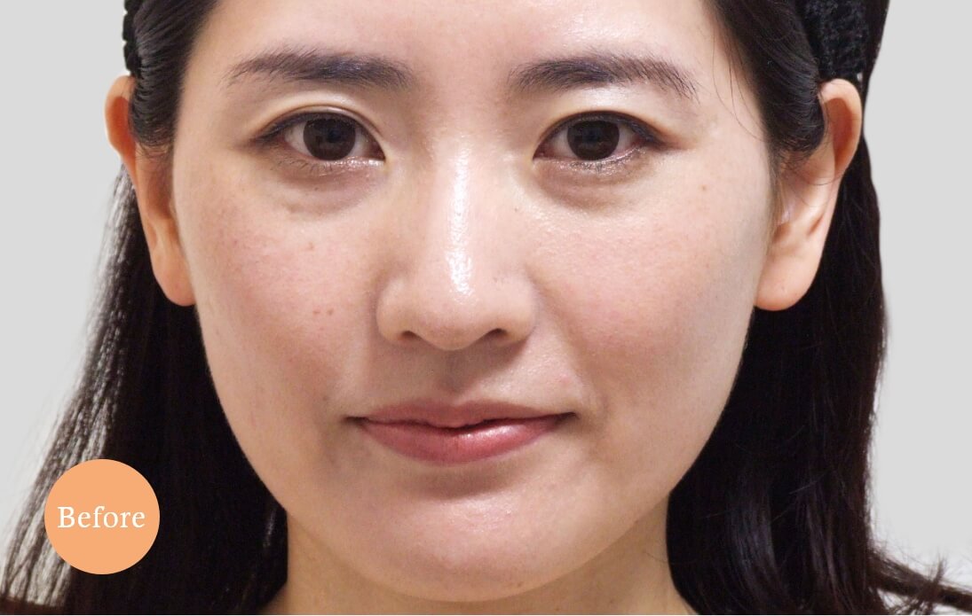 before・after